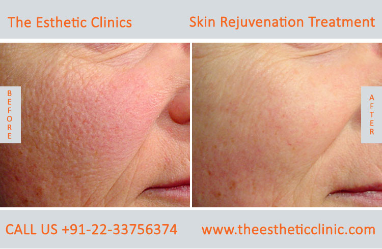 Skin Rejuvenation whitening lightening Laser Treatment before after photos in mumbai india (4)